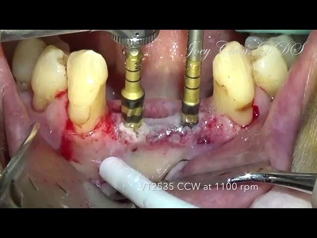 Ridge Splitting with Densah Burs