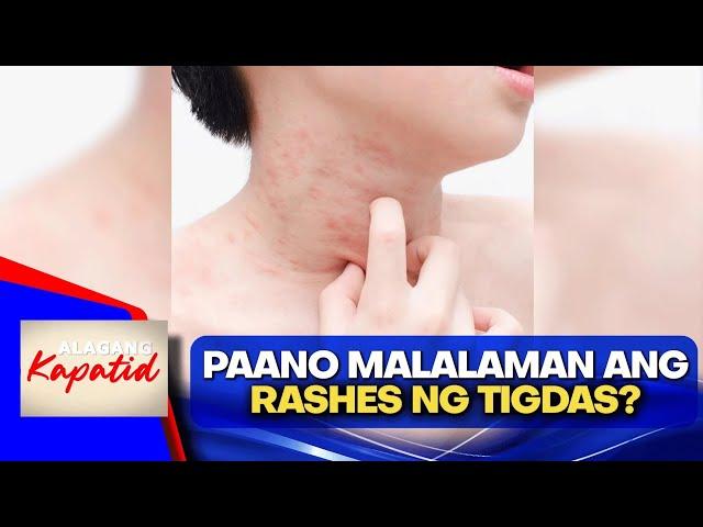 Measles: signs, symptoms, treatment