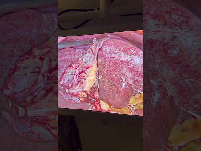 Gallbladder stones ? Treatment ? Surgery ? Laparoscopic surgery ? India I Surat I Gujarat