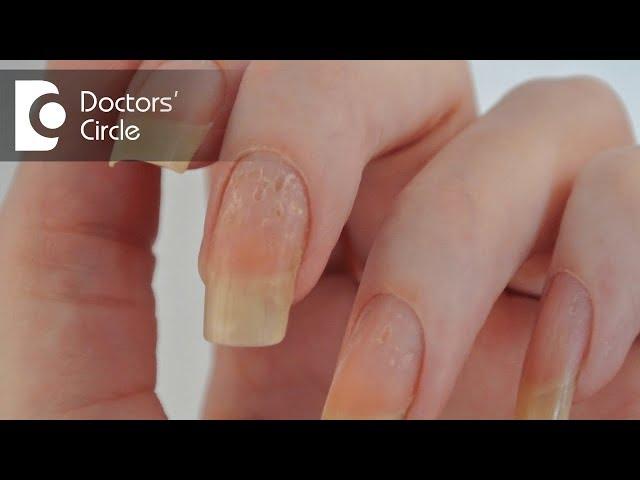 Management of nail pitting - Dr. Aruna Prasad