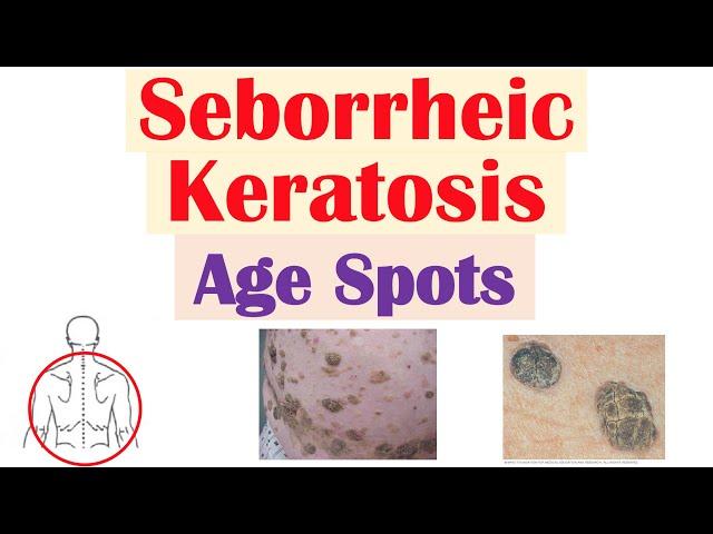 Seborrheic Keratosis (“Age Spots”) | Risk Factors, Causes, Skin Lesions, Diagnosis, Treatment