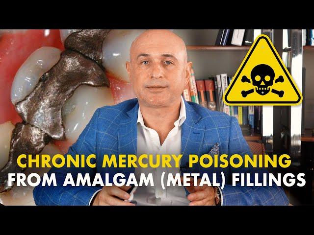 Amalgam (metal) fillings: Common symptoms of chronic mercury poisoning