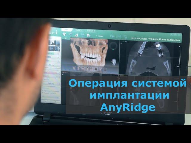 Видео с операции с использованием системы имплантации AnyRidge