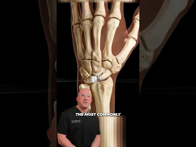 Tiny Wrist Ligament Causing BIG Problems #shorts
