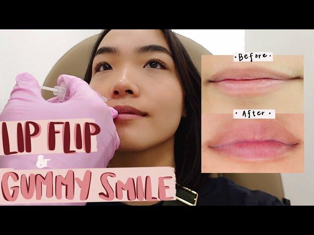 getting my lips done! | lip flip + gummy smile transformation