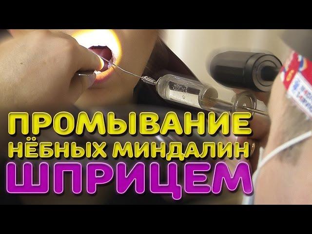 Промывание нёбных миндалин шприцем | Лечим правильно с Владимиром Зайцевым