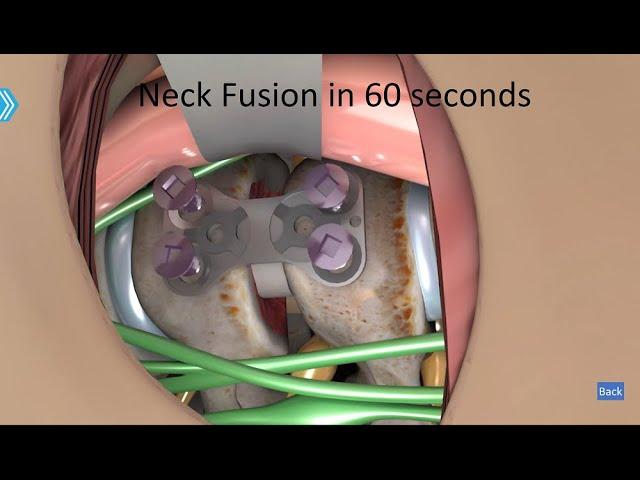 Neck Fusion in less than 60 seconds