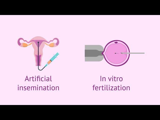 Assisted Reproductive Technology