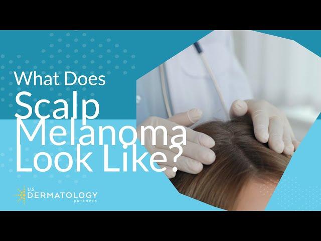 What Does Scalp Melanoma Look Like?