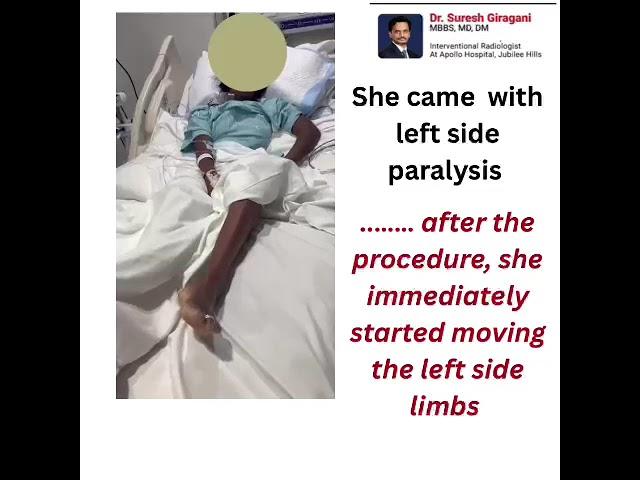 Mechanical Thrombectomy Saves Stroke Patient |  Dr. Suresh Giragani
