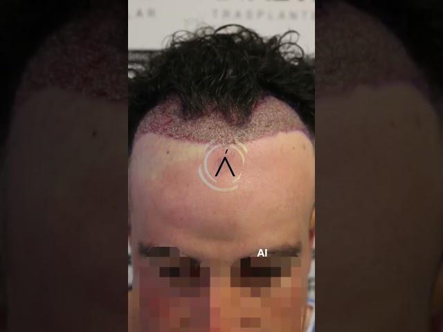 Trasplante capilar resultado | Injerto capilar sin rasurar | Hair transplant before after