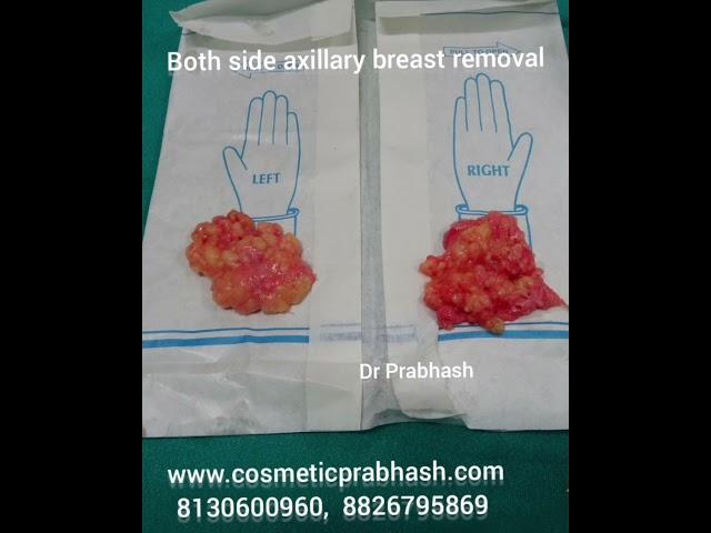 Breast Surgery in Delhi Accessory or axillary breast removal