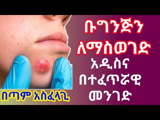 Ethiopia: ቡግንጅን በቤት ውስጥ የማከሚያ ዘዴ/ Boils treatment/Home remedies
