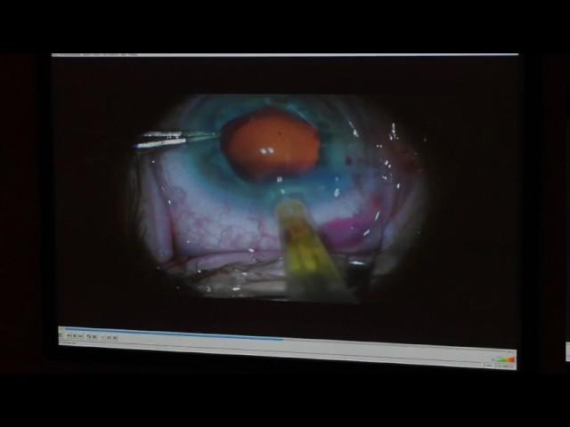 Фемто факоэмульсификация катаракты с использованием кольца Малюгина