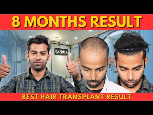 Hair Transplant in Jaipur| Best Results & Cost of Hair Transplant in Jaipur