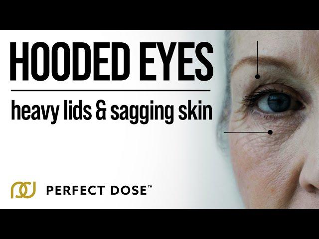 Hooded Eyes - Heavy Lids & Sagging Skin