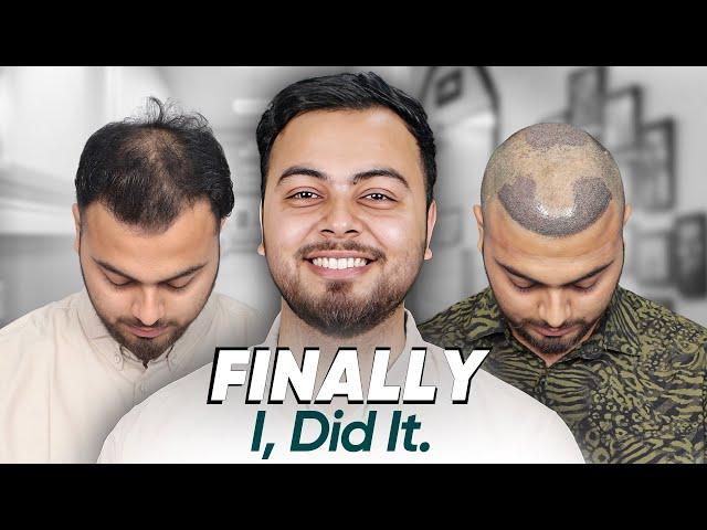 Hair Transplant in Ahmedabad | Best Results & Cost of Hair Transplant in Ahmedabad