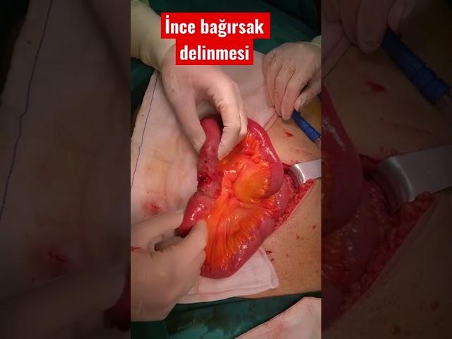İnce bağırsak delinmesi ameliyatı