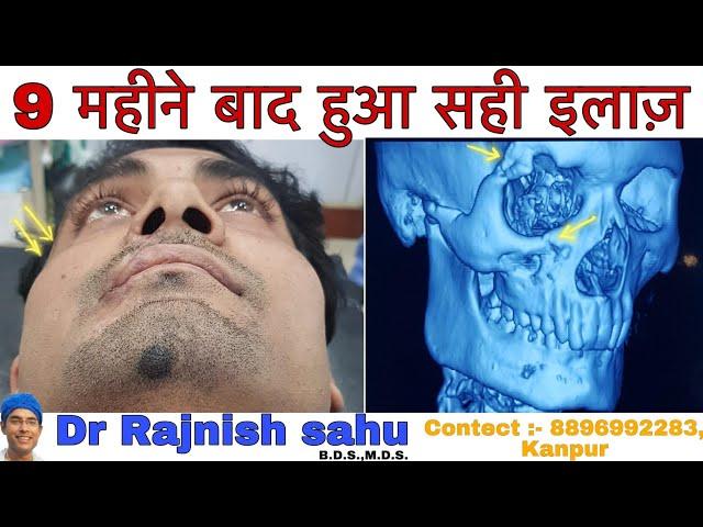 9 महीने बाद हुआ सही इलाज़ || Part - 2 || Cheek Bone Fracture