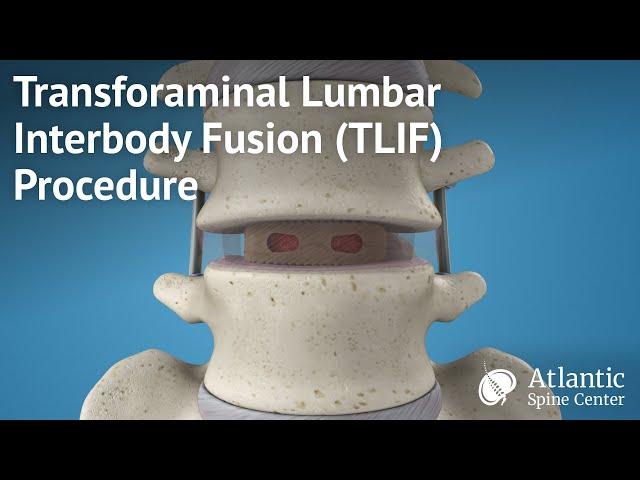 Transforaminal Lumbar Interbody Fusion (TLIF) Procedure