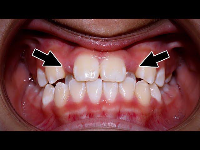 Kéo răng khi niềng răng | Braces pull teeth