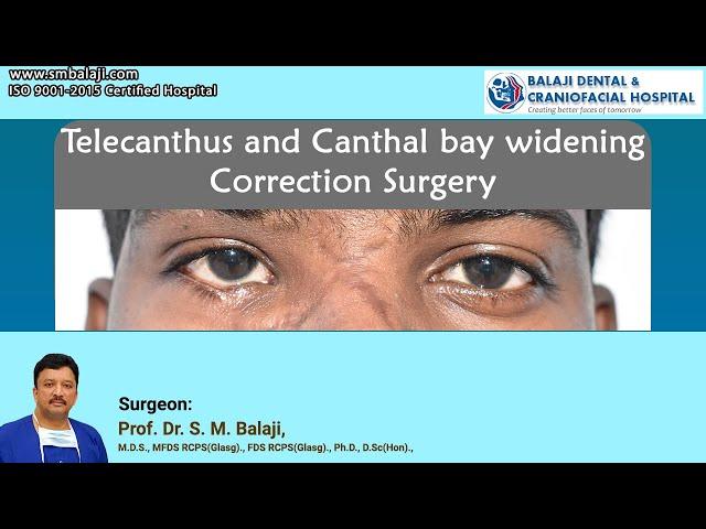 Telecanthus and Canthal bay widening Correction Surgery1