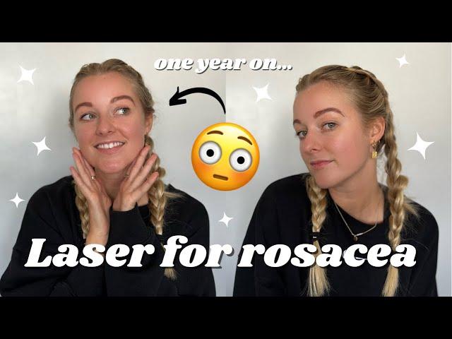 Laser treatment for facial flushing & capillaries | 1 year update! Is it worth it?