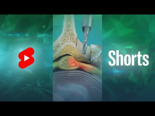 What is Endoscopic Lumbar Laminotomy? | Laminectomy #Shorts