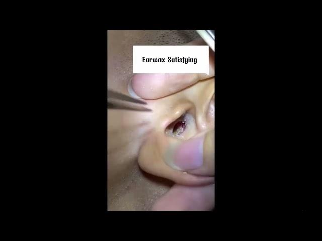 Best Pimple Popping