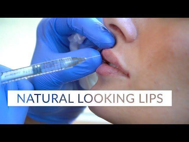 Natural Looking Lip Injections at Barrett Plastic Surgery in Beverly Hills