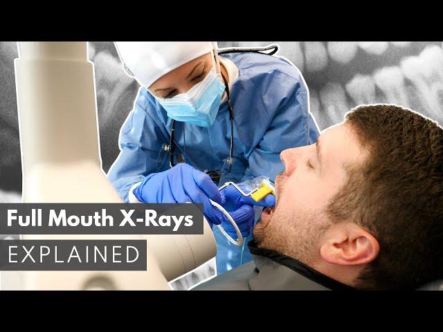 Dental X-Ray Full Mouth Series (FMX) Explained