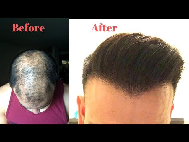 My Hair Transplant Journey