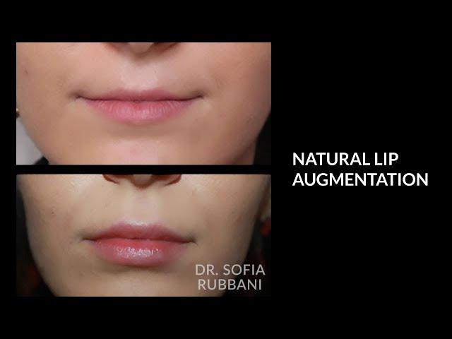 BEFORE & AFTER - Natural Lip Augmentation by Dr. Rubbani