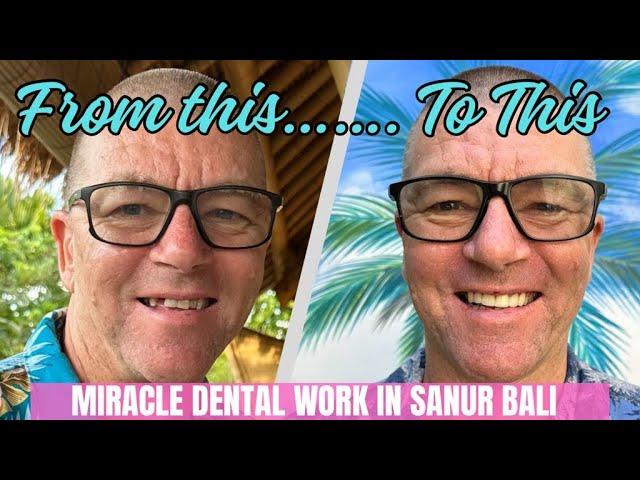 Toothless to Terrific!! AMAZING BALI DENTAL transformation in SANUR