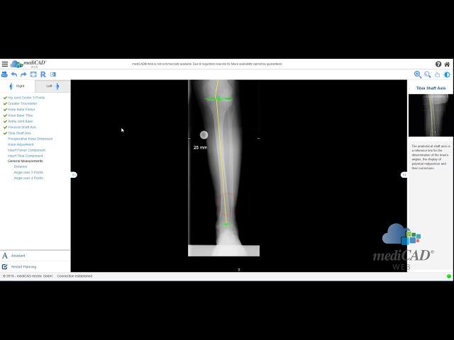 mediCAD Web 1.2 - Demovideo Knee Planning