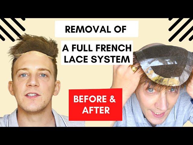 Before and After | Removal of a French Lace system