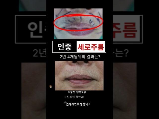 인중세로주름,2년4개월뒤 결과는? #연세자연미 #신촌성형외과 #입술고양이주름영구교정 #인중주름교정#은평성형외과