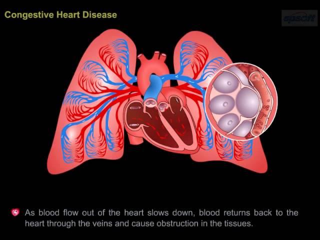 CONGESTIVE HEART DISEASE- OVERVIEW