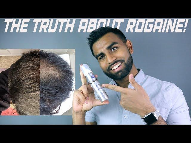 Does Rogaine Work? | 2.5 Years Later | My Results and Review