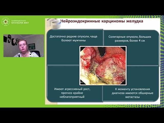 Комплексная эндоскопическая диагностика и лечение НЭО желудка
