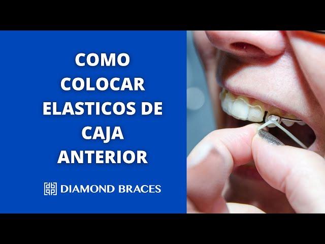 Cómo Colocar Elásticos De Caja Anterior