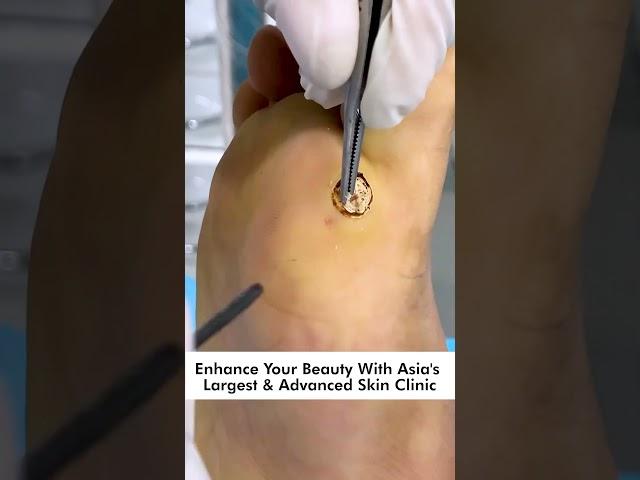 How To Remove Plantar Warts: Understanding, Treating, and Preventing Foot Warts #skinaa_clinic