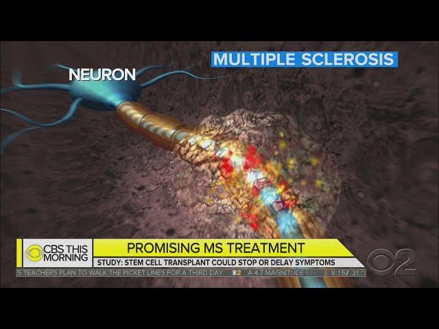 Promising Stem Cell Therapy For Multiple Sclerosis