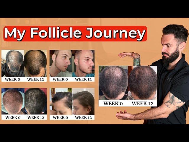 Hair Growth Program - My Follicle Journey Presentation