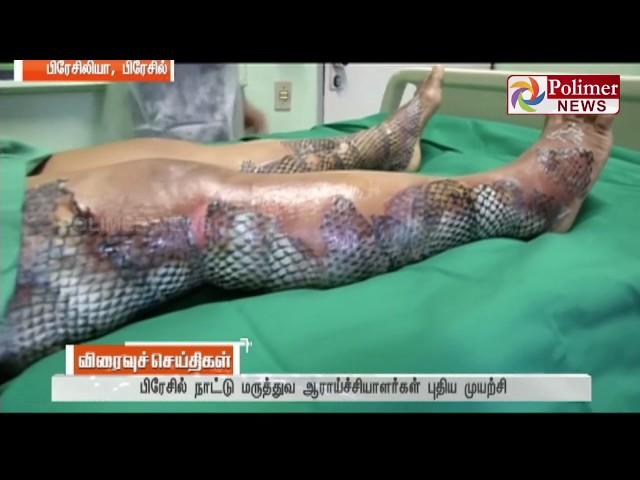 Brazil  uses fish skin to treat skin scars ! | Polimer News | #FishSkinTreatment #Brazil