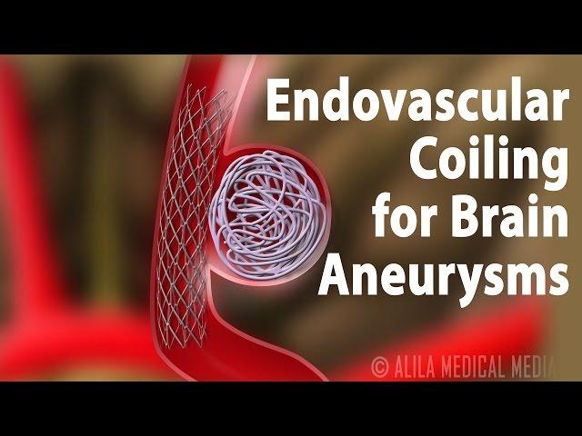 Endovascular Coiling for Brain Aneurysm, Animation.