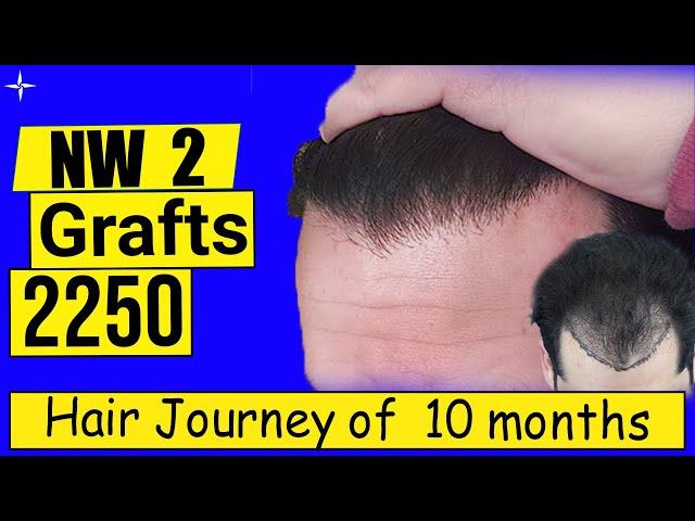 Caucasian Hair Transplant Result in 10 Months , 2250 Grafts,  @Eugenix by Expert Hair Surgeons