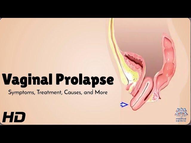 Vaginal Prolapse 101: What Every Woman Should Know