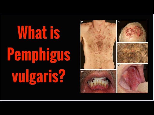 What is PEMPHIGUS VULGARIS? Symptoms, Causes