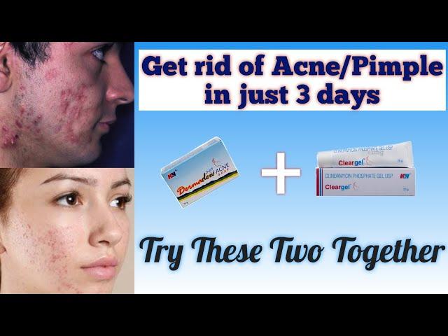 How to remove acne pimples completely| Dermadew acne soap | Clear gel | Girl on the glow|